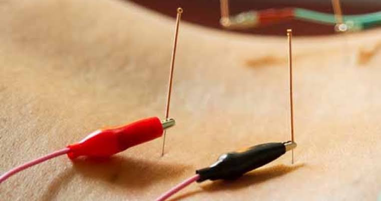 Electro Acupuncture