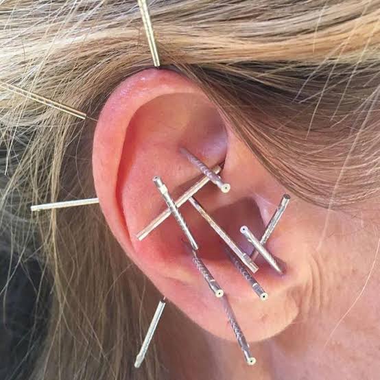 Auricular Acupuncture